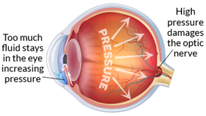 Glaucoma: IOP